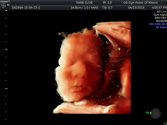 Ultrasound | OB-GYN & Midwifery Associated of Ithaca